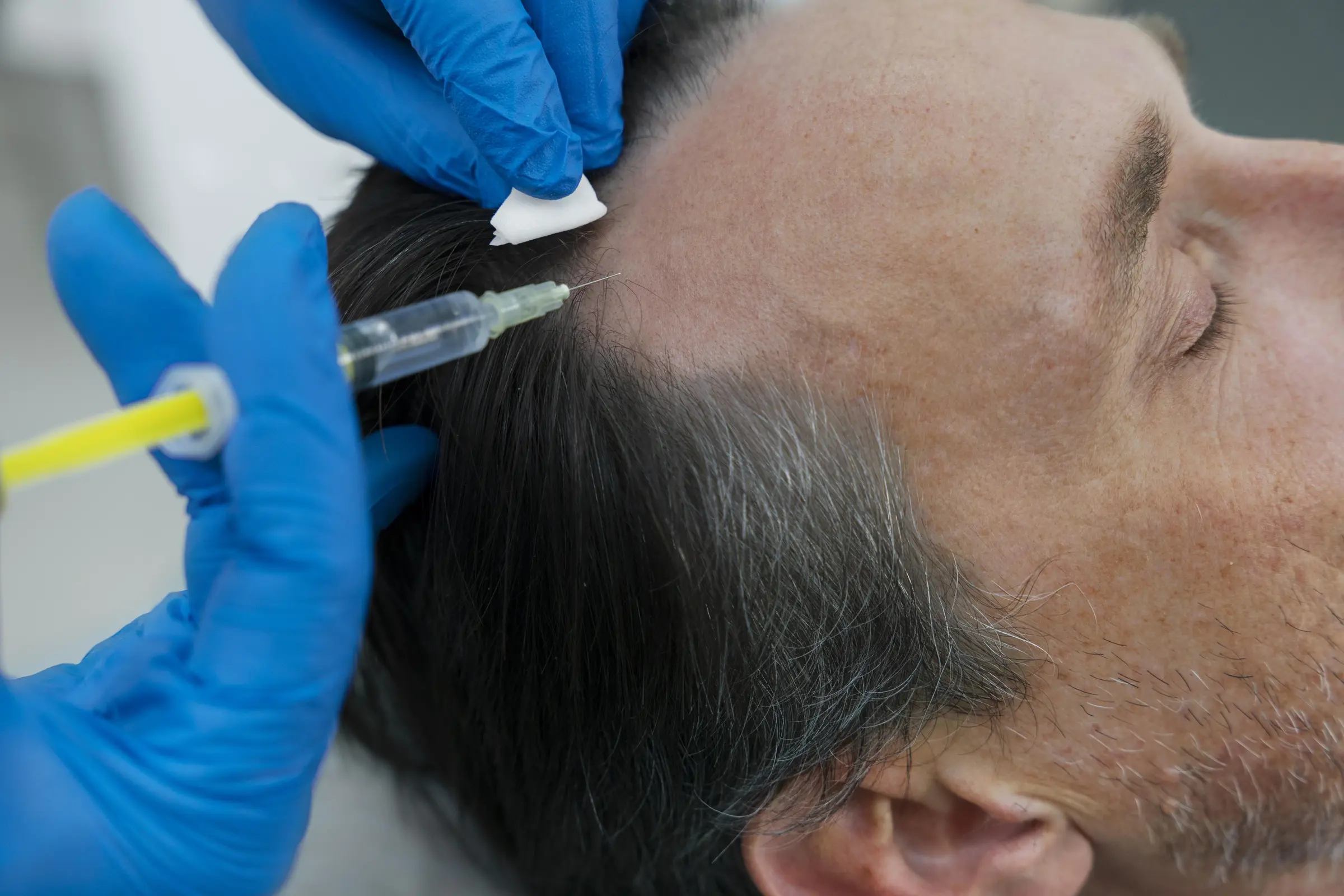 Everything You Need to Know About PRP Hair Treatment